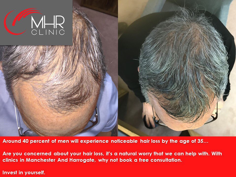 Are you concerned about your hair loss?

It’s a natural worry that we can help with. With clinics in Manchester and Harrogate, why not book a free consultation.