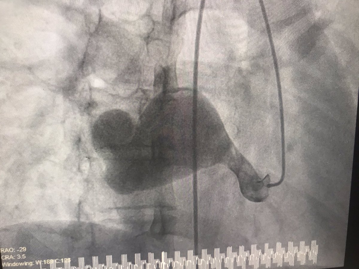 26 yr old RN with SOB and Palp. Echo shows AV shunt from Aorta to RA.  Echo shows a strange jet from the back of the RA through the Tricuspid valve. Angio to determine size.  CTA showed 10-12 mm AV shunt.  RHC shows 25% of CO going through shunt. What’s next?<a href="/SAIFSanAntonio/">SAIF</a>