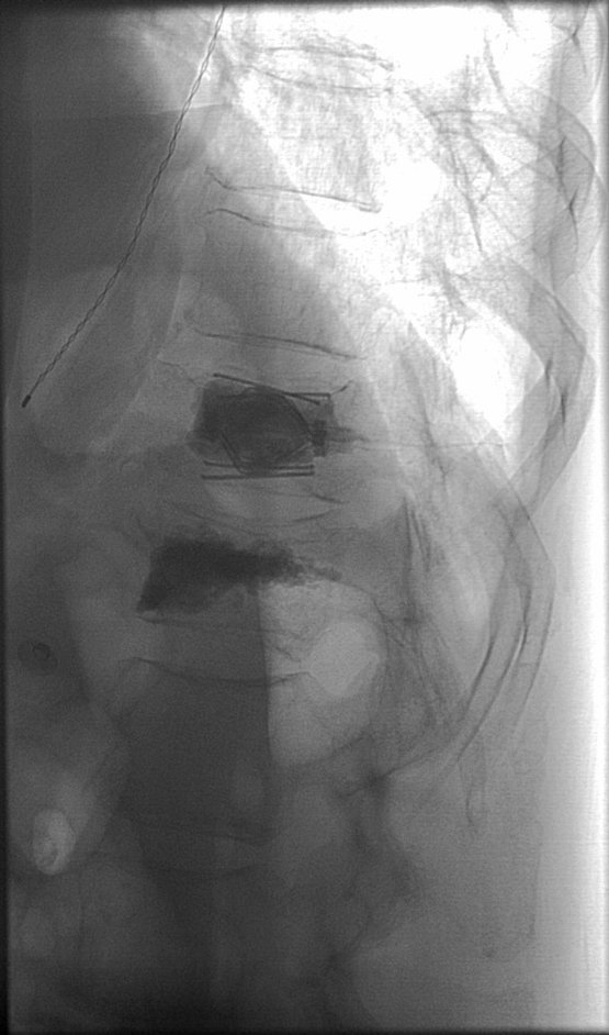 First SpineJack case in Arkansas - Excellent technical and clinical result.