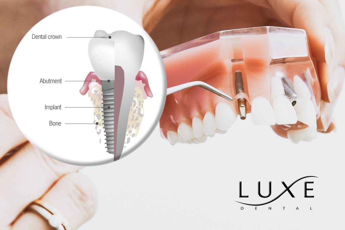 What Problems Could Develop With a Dental Crown?
Discomfort or sensitivity. Chipped crown. Loose crown. Crown falls off......
buff.ly/2EAwaOf