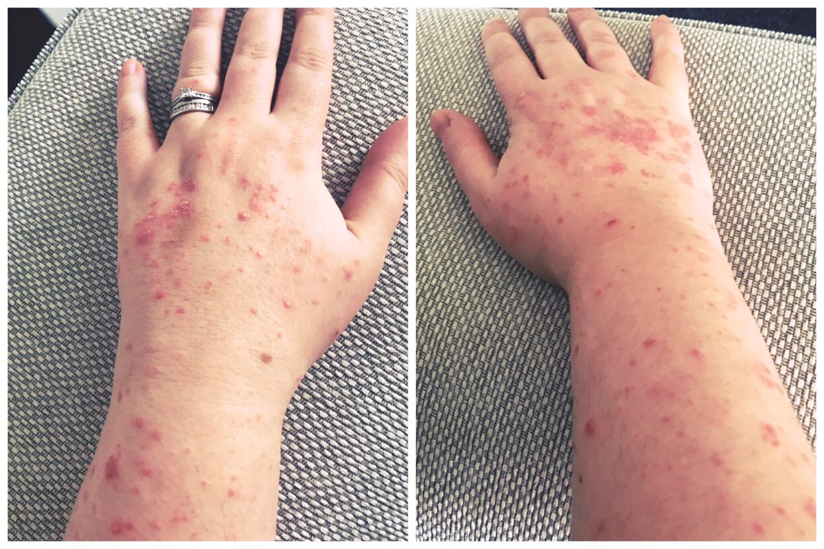 NotJustSkinD33p's tweet photo. Skin is going crackers today ๐ก think itโs gonna be a โwhack the steroid cream on and wear fingerless-elbow length glovesโ day... #psoriasis #itchinglikeabitch #melanoma #stage3 #nivolumab #opdivo #immunotherapy #skincancer #fuckcancer #skinaware #coverupday https://t.co/rE5pSguFLP