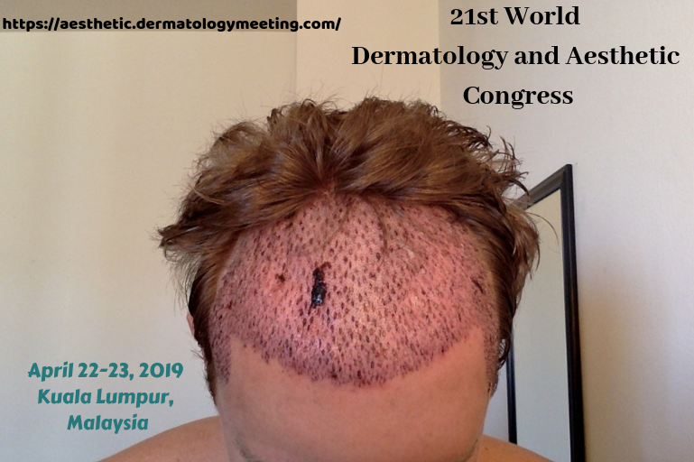 2018Aesthetic's tweet photo. #Hair transplantation is a #surgical technique that removes hair follicles from one part of the #body, called the 'donor site', to a #bald or balding part of the body known as the 'recipient site'. #Submit #article @ https://t.co/kzHAom1MjR https://t.co/ohwjz2my1Z