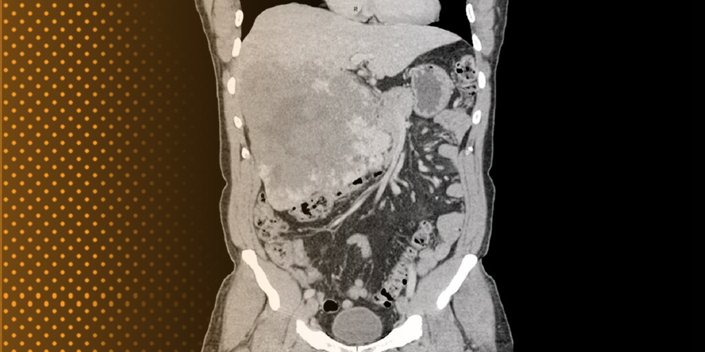 A 55-year-old #woman is found to have a 22-cm #livermass. 
bit.ly/2SqXsu9
