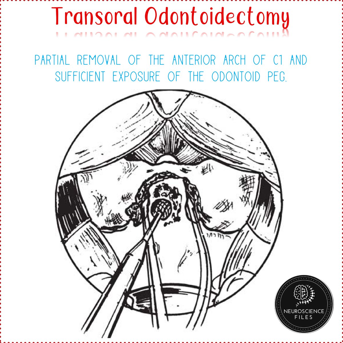 neurofiles1's tweet image. #SpinalWednesday #Odontoidectomy #Spine #Neurosurgery
Transoral odontoidectomy 😊👍🏻
From: Atlas of Neurosurgical Techniques: Spine and Peripheral Nerves; Thieme