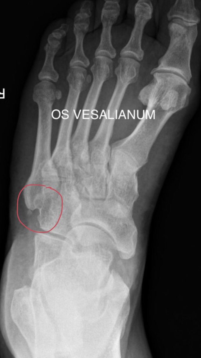 DrSergiohorte's tweet photo. 🆘DIAGNÓSTICO DIFERENCIAL    DOLOR 5 MTT🆘 
✅➊ Os Peroneum (hueso accesorio en cuboides intra T.Peroneo Largo). 
✅➋ Os vesalianum (hueso accesorio base 5 Mtt en T. Peroneo Corto).
✅➌ Enfermedad de ISELIN (Apofisitis por tracción repetidas TPCorto).
✅➍ Fractura base 5 MTT https://t.co/UfJJnnopal