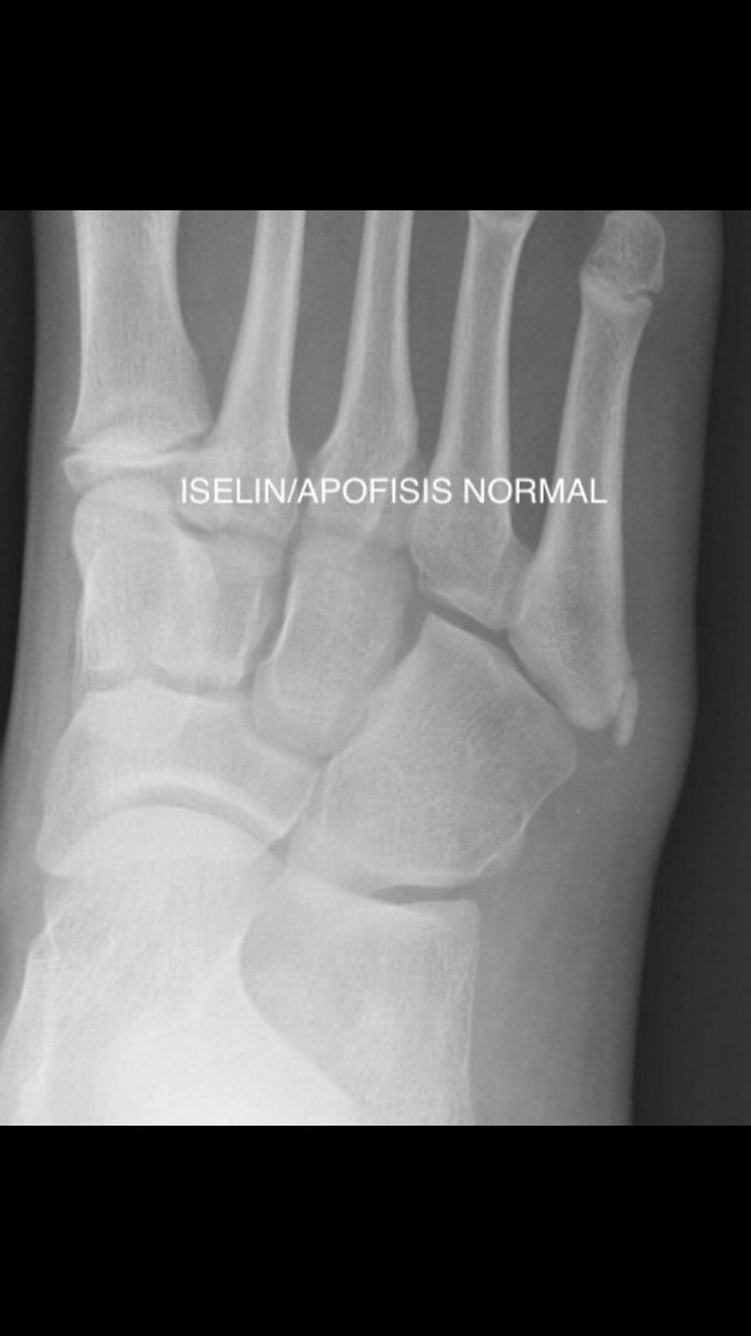 DrSergiohorte's tweet photo. 🆘DIAGNÓSTICO DIFERENCIAL    DOLOR 5 MTT🆘 
✅➊ Os Peroneum (hueso accesorio en cuboides intra T.Peroneo Largo). 
✅➋ Os vesalianum (hueso accesorio base 5 Mtt en T. Peroneo Corto).
✅➌ Enfermedad de ISELIN (Apofisitis por tracción repetidas TPCorto).
✅➍ Fractura base 5 MTT https://t.co/UfJJnnopal