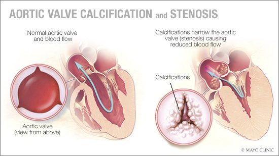 Mayo Clinic auf Twitter: „Aortic valve #calcification is a condition in which calcium deposits form on the aortic valve in the heart. These deposits can cause narrowing at the opening of the #
