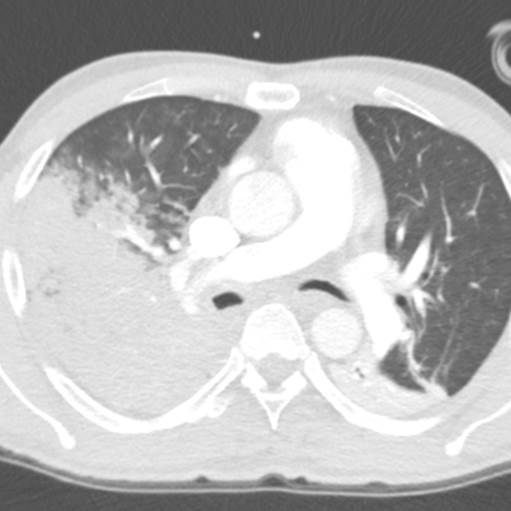 CtSpectral's tweet image. Pneumonia and atelectasis on #SpectralCT.
RLL pneumonia: Volume expanded, edges indistinct on conventional CT, markedly decreased perfusion on iodine map.
LLL atelectasis: Volume loss, sharp edge and increased iodine uptake.

#ChestRadEd #radres