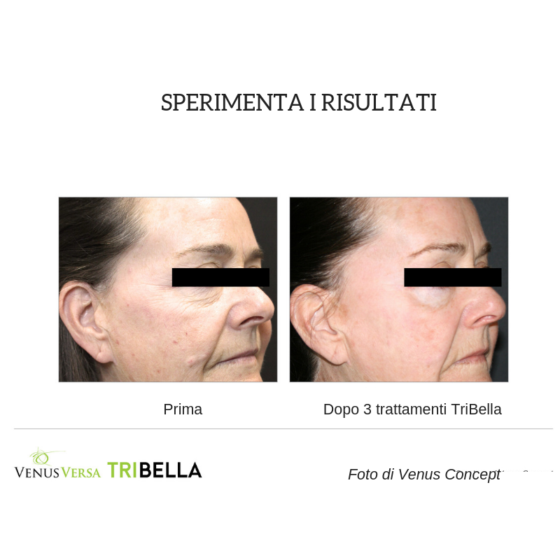 VenusConceptIT's tweet photo. Ecco la combo di trattamenti più efficace che esista: è il #TriBella, il trattamento viso #VenusConcept che unisce 3 superiori tecnologie in un'unica seduta. RF MultiPolare, RF Nanofrazionat,  IPL di ultima generazione. 
https://t.co/LgQeymdaGP #VenusBeauty https://t.co/e5TKJILgZC