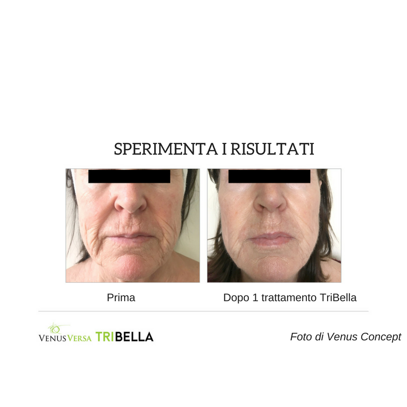 VenusConceptIT's tweet photo. Ecco la combo di trattamenti più efficace che esista: è il #TriBella, il trattamento viso #VenusConcept che unisce 3 superiori tecnologie in un'unica seduta. RF MultiPolare, RF Nanofrazionat,  IPL di ultima generazione. 
https://t.co/LgQeymdaGP #VenusBeauty https://t.co/e5TKJILgZC