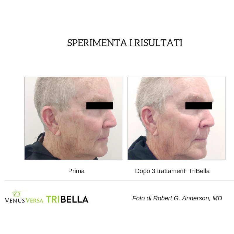 VenusConceptIT's tweet photo. Ecco la combo di trattamenti più efficace che esista: è il #TriBella, il trattamento viso #VenusConcept che unisce 3 superiori tecnologie in un'unica seduta. RF MultiPolare, RF Nanofrazionat,  IPL di ultima generazione. 
https://t.co/LgQeymdaGP #VenusBeauty https://t.co/e5TKJILgZC