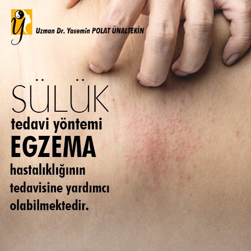YUnaltekin's tweet photo. https://t.co/aVbIexa0WW
Sülüğün salyasındaki enzimler vesilesi ile egzema gibi cilt rahatsızlıklarında sülük tedavisi fayda sağlayabilmektedir.
#şifanızdaimolsun #ankara #akupunktur #proloterapi #nöralterapi #prp #hacamat #sülük #leech #hirudoterapi #canlıeczane #varis #sivilce https://t.co/gS0AUs6Ahs