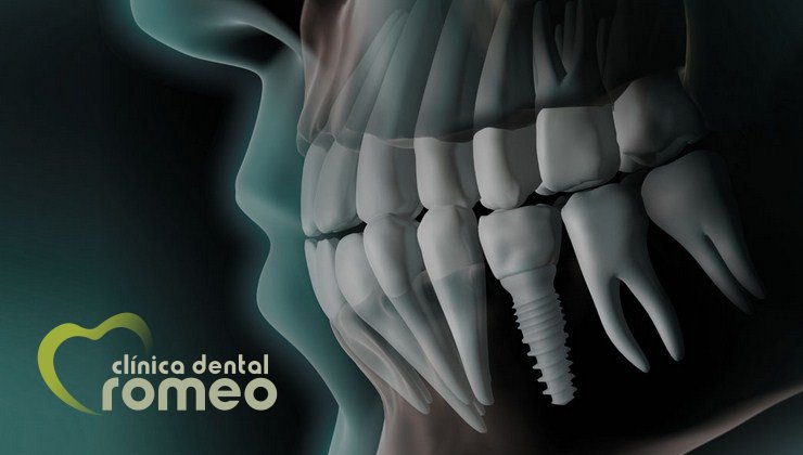🤔¿Cómo prefieres tus implantes❓
👌Escoje un implanes de cerámica de alto rendimiento.
 ✔Biocompatible - Optima tolerancia del cuerpo.
 ✔Estética - Ceramica blanca.
 ✔Seguro - Excelente con las encías.
 #Implantologia #ImplanteBlanco #ImplantesCeramicos #Implantesdentales