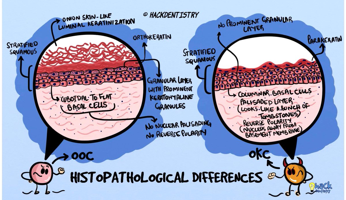 hckdentistry's tweet photo. Did you know the differences between orthokeratinized odontogenic cyst and odontogenic keratocyst? Well, if you ever wanted to dive deeper 👉 https://t.co/Sj8aTrQhnN
#hackdentistry #dentistry #oralpathology #oralmedicine  #odontogeniccyst #orthokeratinizedodontogeniccyst #dental https://t.co/cxfpqgCxUH
