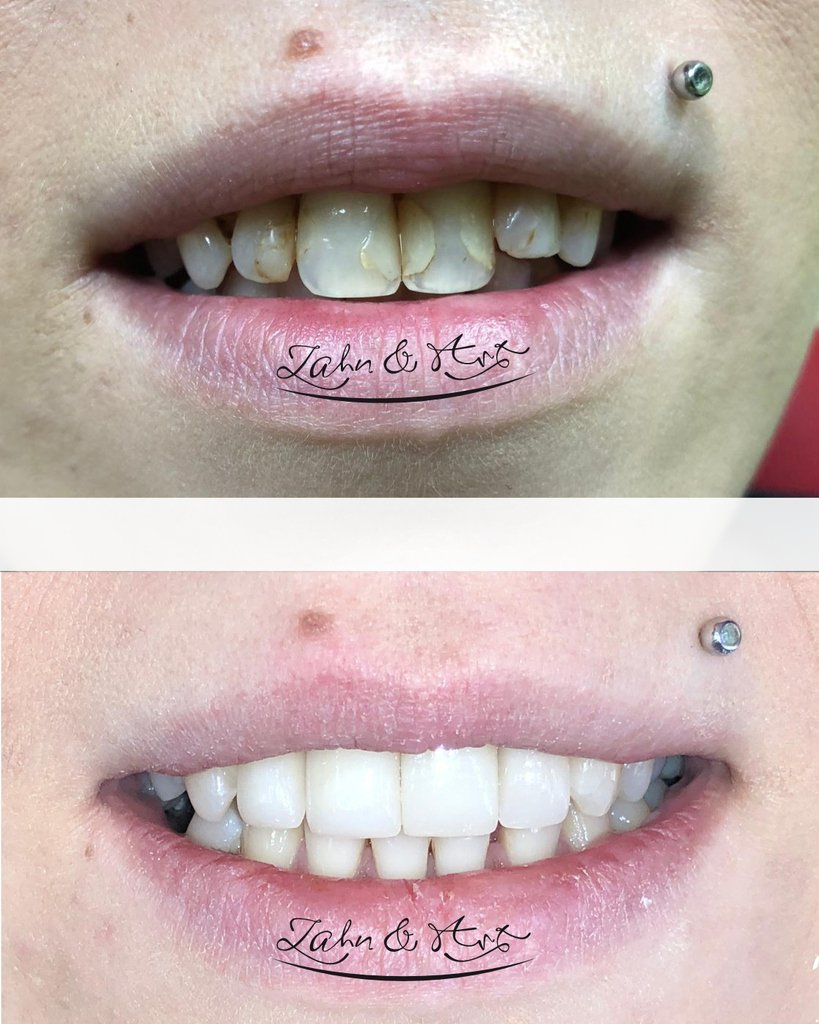ZahnundArt's tweet photo. Neues Lächeln an einem Tag - quasi „togo“. Das obere Bild entstand morgens und das untere Bild nach dem Mittag.
#porcelainveneers #cosmeticdentistry #smilemakeover #smiledesign #smilemaker #teeth #smile #veneers #lächeln #zähne #cadcam #zahnersatz #beforeafter #vorhernachher https://t.co/DIhjNnqJ9m