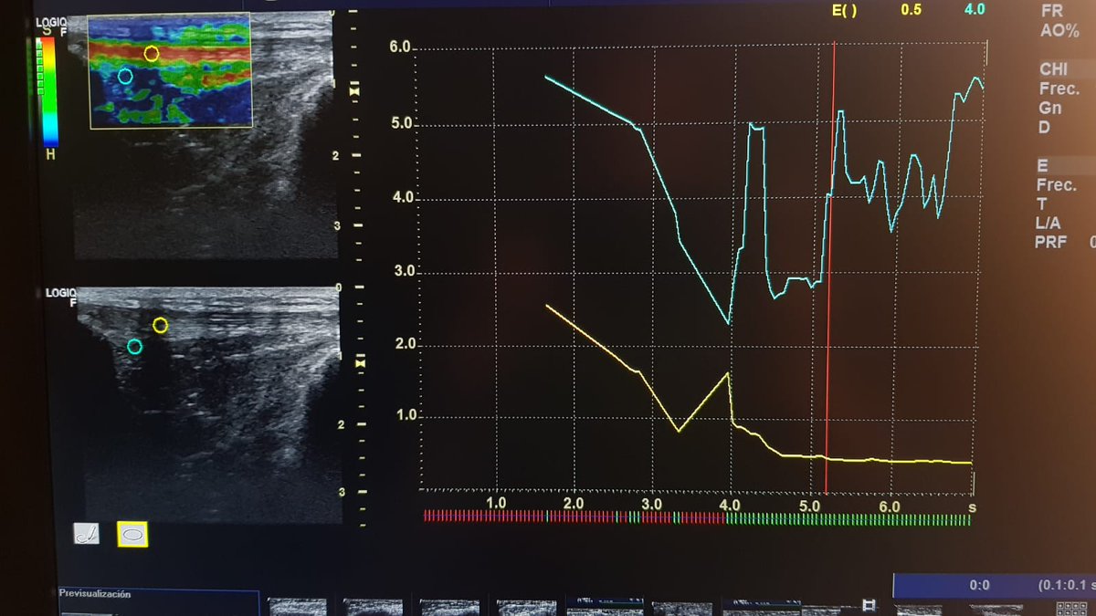 📌Logiq view
📌Elastografía 
📌Cuantificación en elastografía

Estas son tan solo 3 de las cuestiones que abordarán <a href="/Ferdelato/">Fer ; )</a> y Yanire Cantón de <a href="/GEHealthcare/">GE HealthCare</a> en la Jornada de #Optimización de la Imagen que realizamos el 8 de marzo en Madrid.

📩 mr.martin@prim.es
☎️ 91.334.2456