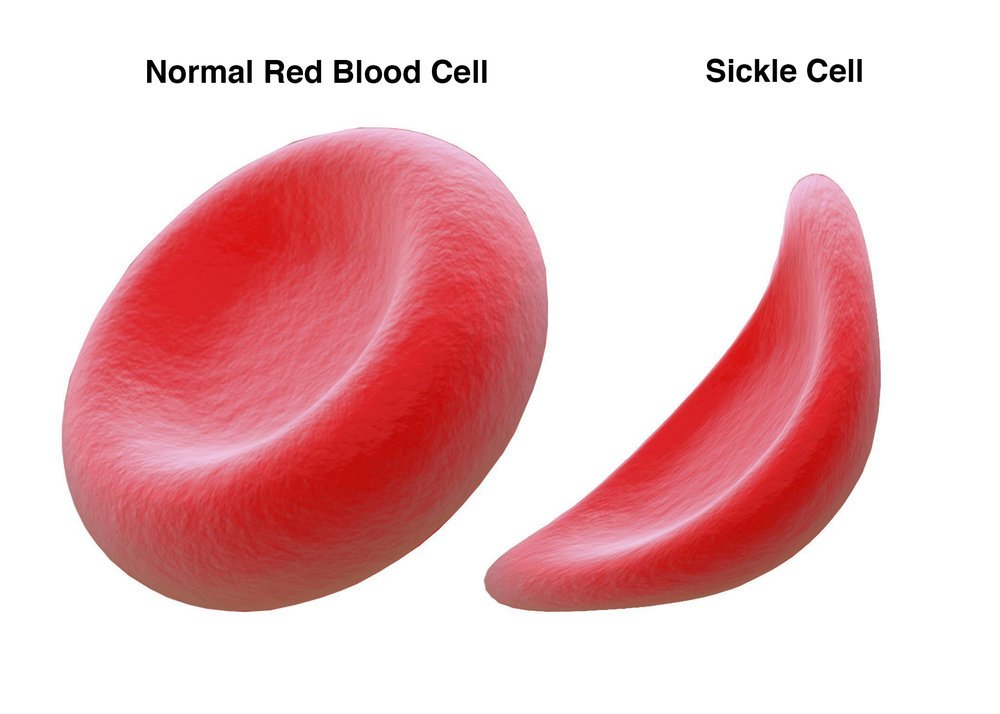 ConquerSCD's tweet photo. #SickleCell Disease affects 100,000 people in the U.S. Learn more about this rare disease, on #RareDiseaseDay. https://t.co/ybBTH1iKrw https://t.co/dxDNeJapD6