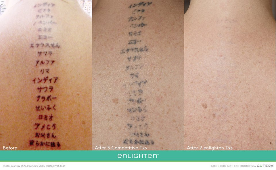 #Enlighten de #Cutera puede borrar un #tatuaje no deseado en un 40% menos de sesiones que otros equipos tradicionales #cuteraspain #medicinaestética #tattooremoval  #adiostatoos #pieltatuada #esteticacorporal #laserenlighten #quitartatuaje