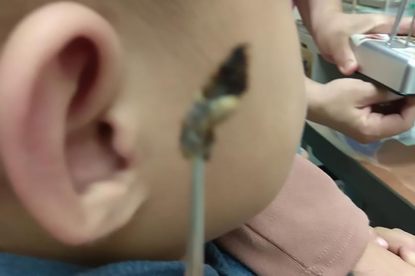 デカっ 母親の声が聴こえない男児を病院に連れて行くとこんな耳垢が溜まっていたことが判明 Edamame