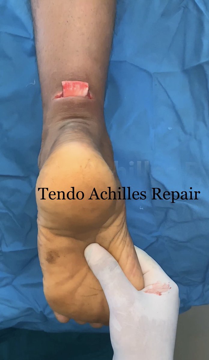 DrBembde's tweet photo. https://t.co/joLkME6RmD  #TendonRepair , #HandInjury , #Ankle &amp; #FootInjury , #NerveRepair ,#CompoundFractures of leg &amp; hand. #ReconstructivePlasticSurgery #TendoAchillesRepair #FootClinic #HandClinic #ReconstructivePlasticSurgery #PlasticSurgeryAurangabad https://t.co/sbmyCh2v9l