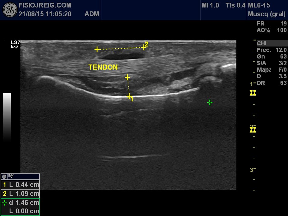 Rotura de la polea en tendón del dedo de la mano. #Ecografia #formacion <a href="/fisiojreig/">fisiojreig</a> #LOGIQS7