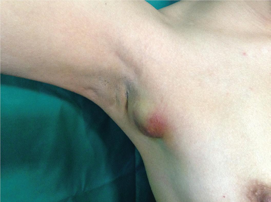 Linfadenopatia Axilar