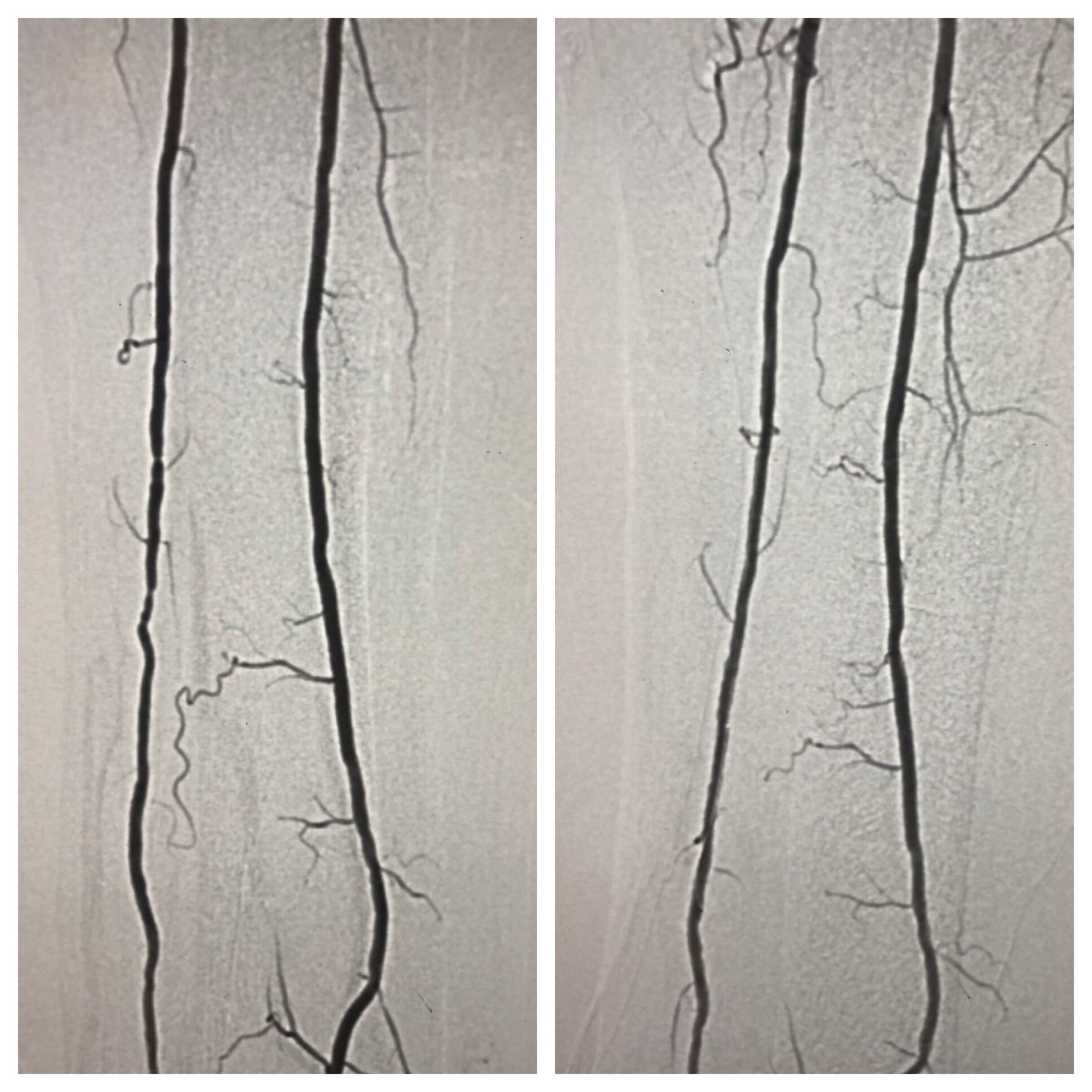 matheenkhuddus's tweet image. Vessel size and extent of calcium in tibial arteries frequently misjudged. #OCT of the left PTA reveals extensive medial calcification and MLD by EEL 3.5-4.0mm. Treated w/ OA and PTA w/ 4mm balloon for wound healing w/ good result #imagefirst #SCAIPAD