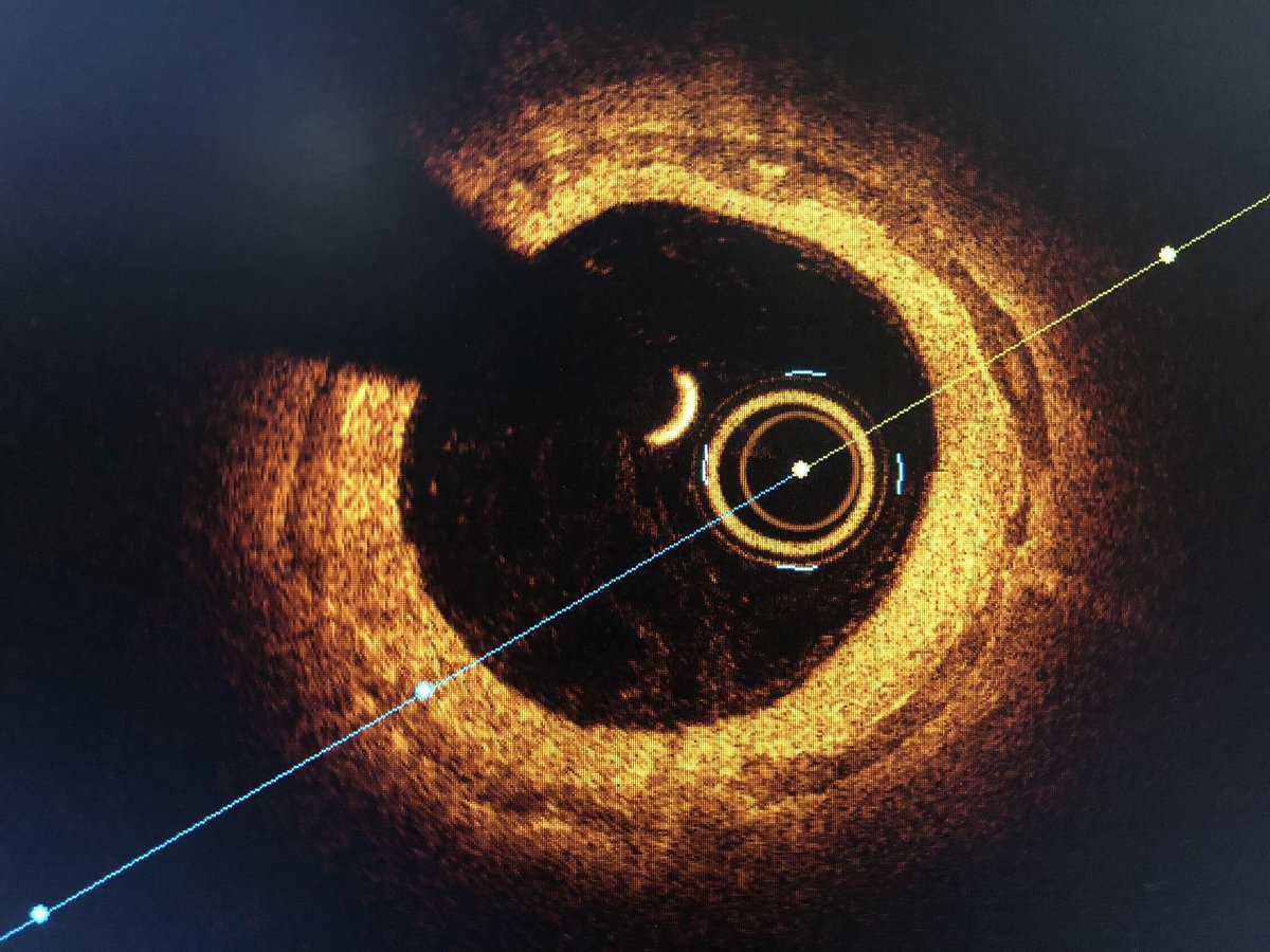 matheenkhuddus's tweet image. Vessel size and extent of calcium in tibial arteries frequently misjudged. #OCT of the left PTA reveals extensive medial calcification and MLD by EEL 3.5-4.0mm. Treated w/ OA and PTA w/ 4mm balloon for wound healing w/ good result #imagefirst #SCAIPAD