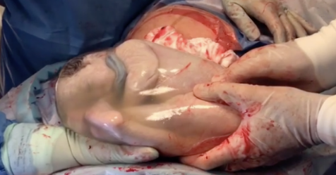 This Video Shows a Baby Being Born Inside His Amniotic Sac bit.ly/2EmGesR