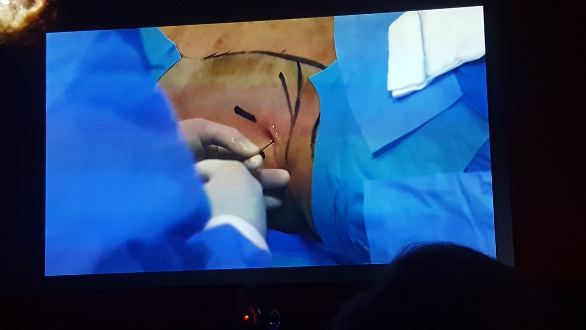 MicheleTalso's tweet photo. Great ECIRS  performed by @scoffonecesare and Cecilia Cracco: he pointed the site of entrance before the puncture, based on the landmarks drawn and he finally got it in one shot @CAOItalianLaser @LumenisU #ECIRS https://t.co/TUfaHKGU4o