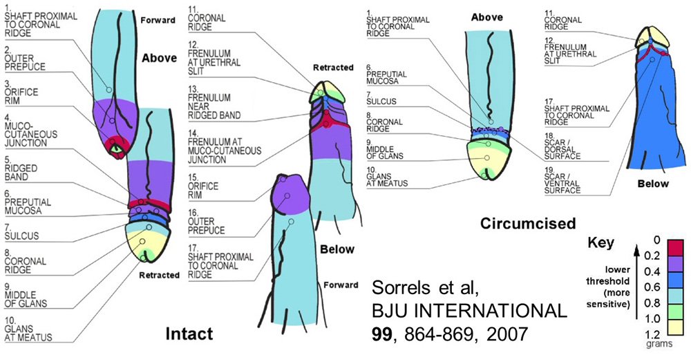 The_More_yaKnow's tweet photo. Most people do not know that:

MALE CIRCUMCISION REMOVES THE MOST SENSITIVE PART OF THE PENIS.

The most sensitive part of a circumcised penis is the scar where the sensitive skin was removed (sometimes a small bit of this skin is left over)

PLEASE DO NOT CIRCUMCISE YOUR CHILD https://t.co/oDHarkemc8