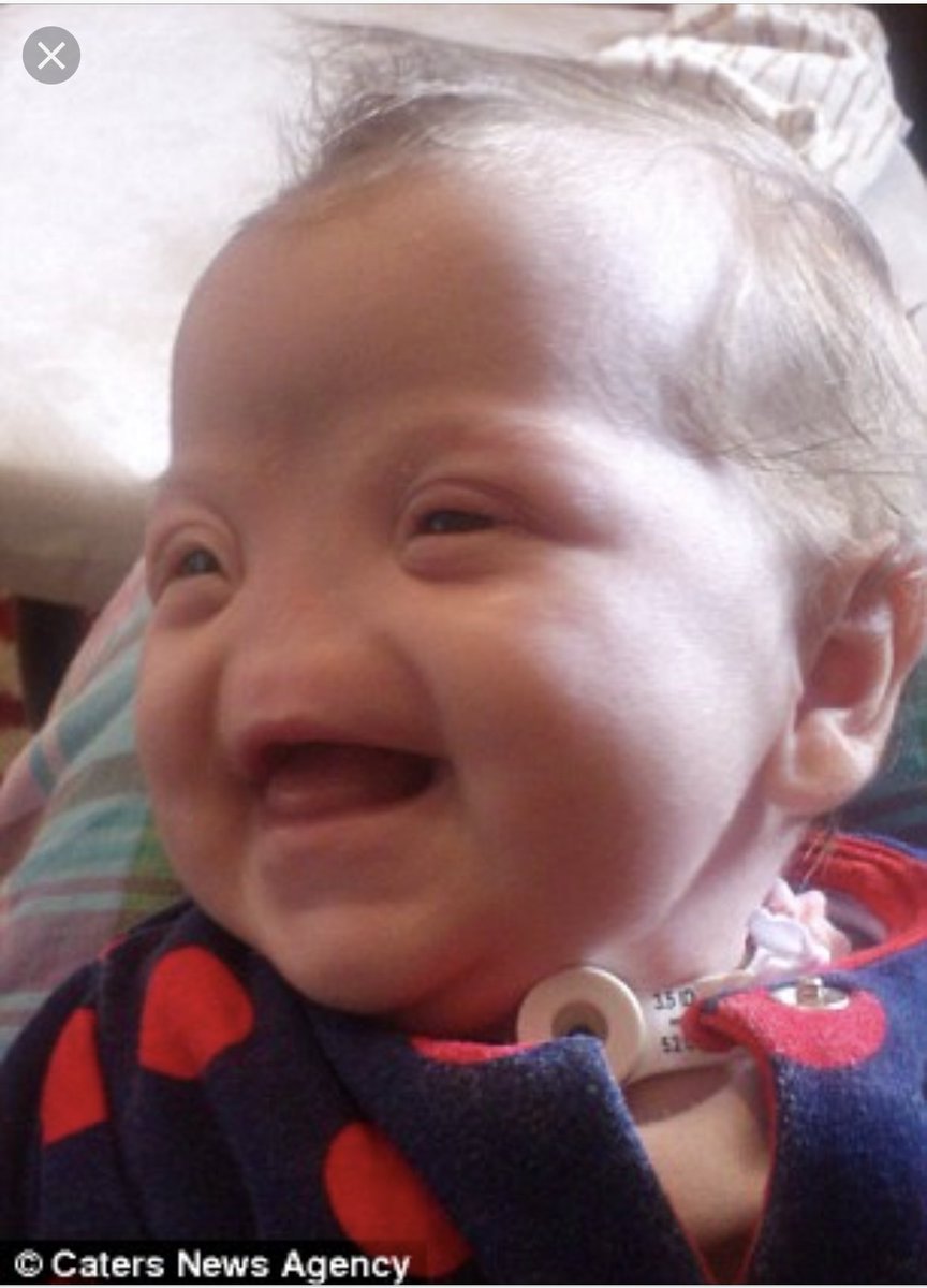 "تيسا ايفانز" تعاني من حالة نادرة جدا ،
حيث ولدت بدون أنف ، وبدون جيوب أنفية ،
✨
في كل العالم يوجد أقل من ٤٠ حالة فقط تم تشخيصها الى الان ،،