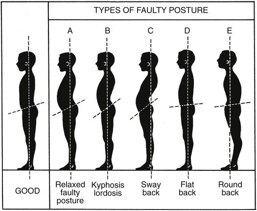 Treatment of spinal curvature. Постурология. Прямая спина инфографика. Back types. Постура.