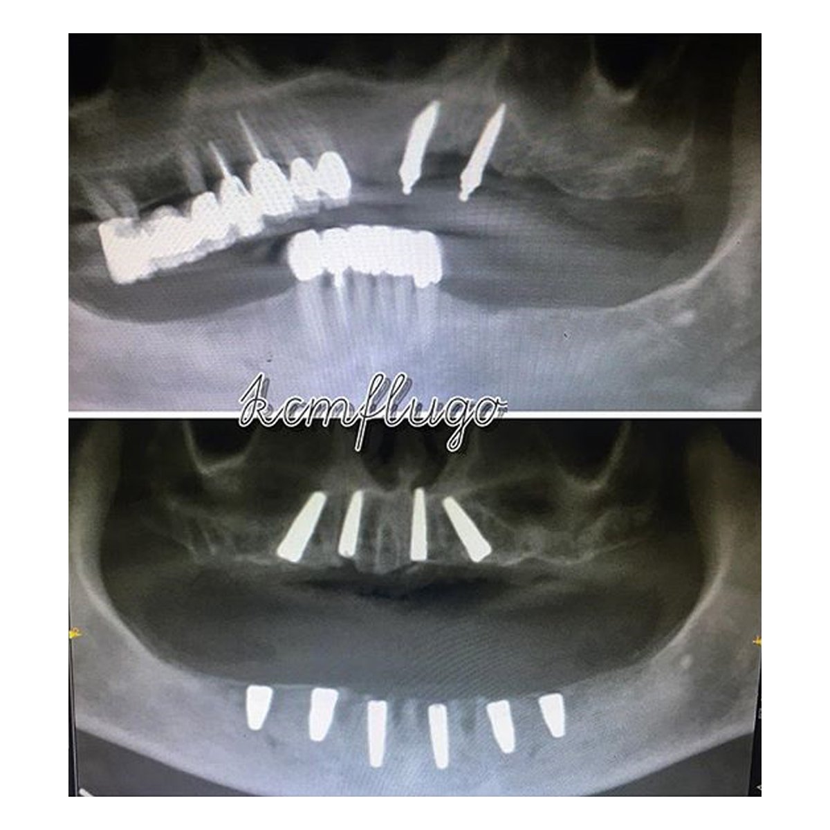 This is how it look your implants after your dental treatment. 😉
➡ allon4cancun.com
#dentalimplants #maxillofacialsurgeon #dromarlugo