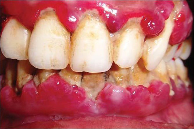Md3ziz's tweet photo. Scorbutic Gingivitis: is Severe vitamin C deficiency is well known to lead to a severe periodontal syndrome. which is characterized by ulcerative gingivitis and rapid periodontal pocket development with tooth exfoliation.
#made_easy #Perio https://t.co/Ycbcew0Y3E