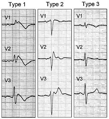 All EMS providers should know/recognize #Brugada EKG's.  Usually healthy young patients who look well and fool us.  These are signs of a significant underlying pathology that can lead to #SuddenCardiacDeath.  

Young pt + syncope + this EKG = go to ED

 #GatheringEagles19