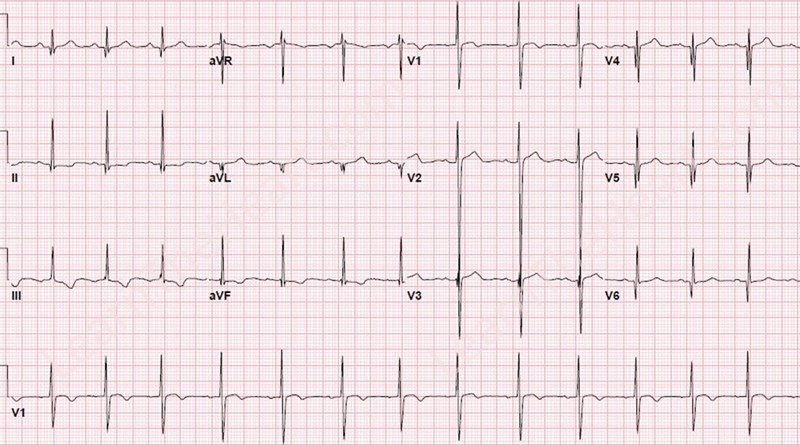 All EMS providers should know/recognize #HOCM EKG's.  Usually healthy young patients who look well and fool us.   These are signs of a significant underlying pathology that can lead to #SuddenCardiacDeath.    

Young pt + syncope + this EKG = go to ED   

#GatheringEagles19