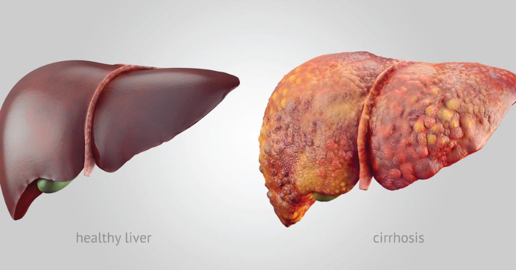 WebMD's tweet photo. Too much of certain foods can make it harder for your liver to do its job. Over time, that may lead to inflammation, which in turn could cause cirrhosis. https://t.co/iAnzjDFfJF https://t.co/nPvOMFvMI1