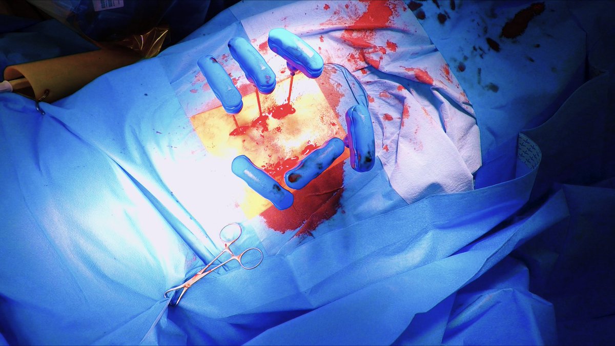 realbrainbook's tweet photo. https://t.co/DtkeS8J5CW

Please retweet and enjoy the new video!

#neurosurgery #spine #meded #surgery #GoPro #SoMe4Surgery https://t.co/Pe4uYXwFQX