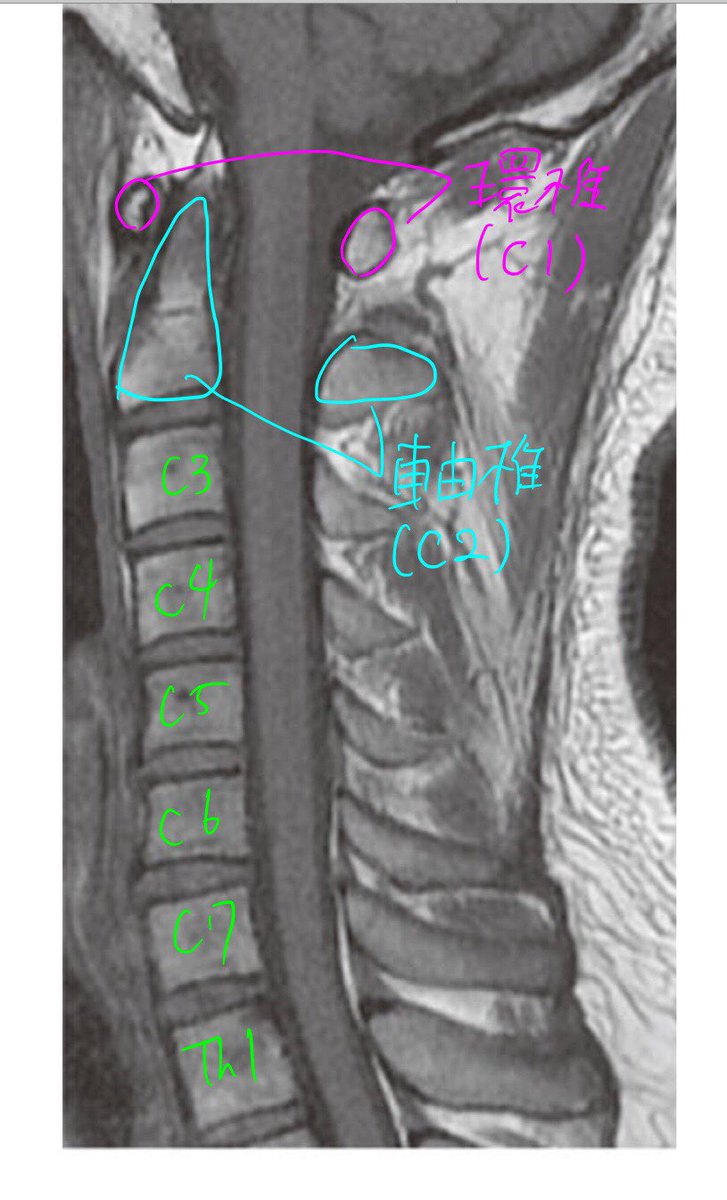 まつやま Pa Twitter 質問対応のために作ったものが上出来で Lineに載せるかonedriveに載せるかで迷った結果twitterに投稿 頸椎 腰椎のmriの見方 需要があったらlineに載せるかも