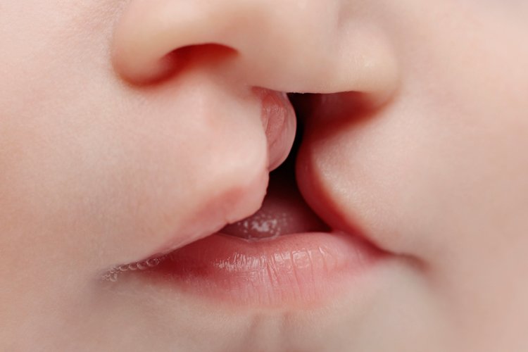 ovi_wce's tweet photo. - Cleft lip and cleft palate
- Club foot
- Spina bifida
- Phenylketonuria
- Edward's Syndrome

If a baby is born with a part of the body missing or malformed, it is called a structural birth defect. Heart defects are the most common type of structural defect.

#BirthDefectsDay https://t.co/hMQ0qKsyad