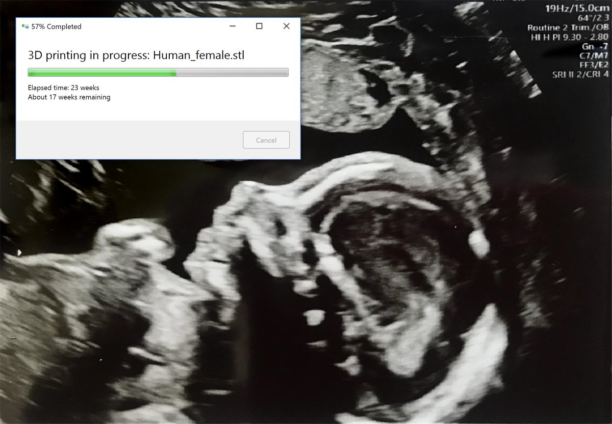 Fetal ultrasound with an overlaid dialog box that reads: 3D Printing in progress: Human_female.stl 57% completed, elapsed time: 23 weeks, about 17 weeks remaining