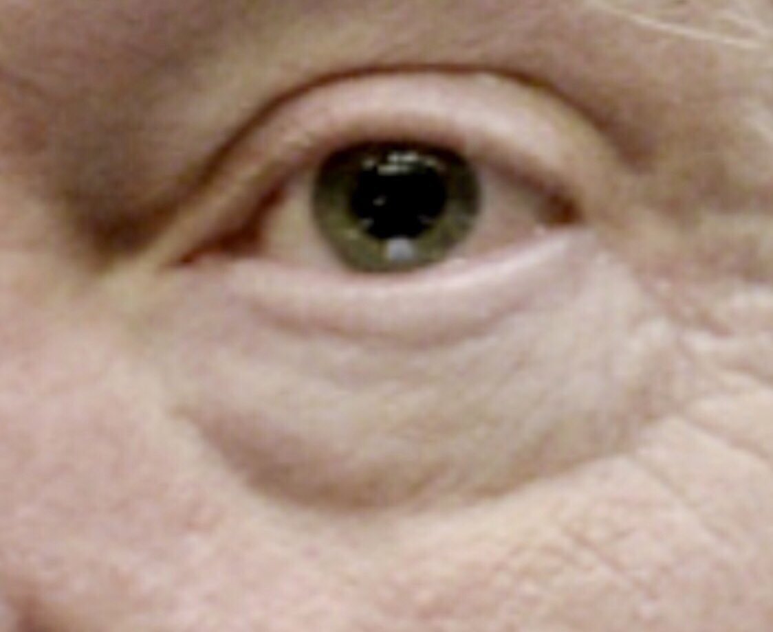 SIGNS OF ADDERALL ABUSE:

Insomnia (3am tweets) ✅

Agression ✅

Paranoia ✅

Dry mouth ✅

Dilated pupils ✅

Faster Breathing ✅

Sweating ✅

Hallucinations ✅

Incomplete thoughts ✅

Rambling speech ✅

Breathlessness ✅

DRUG TEST @realDonaldTrump