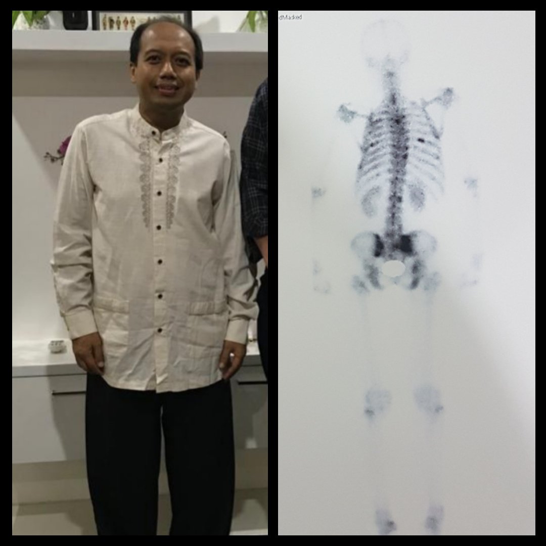 Pantesan tubuh saya makin miring saat berdiri atau berjalan. Hasil foto MRI memang menunjukkan tulang belakang saya makin bengkok atau skoliosis. Kanker menyebabkan skoliosis. Sakit rasanya.

Makanya teruslah bersyukur kepada Allah SWT. Sehat itu mahal. Jagalah kesehatan.
