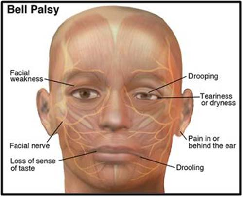 NeurosciScience's tweet photo. Bell's palsy is a type of facial paralysis that results in an inability to control the facial muscles on the affected side.[1] Symptoms can vary from mild to severe.[1] They may include muscle twitching, weakness, or total loss of the ability to move face. https://t.co/Kx6Jz8yorc