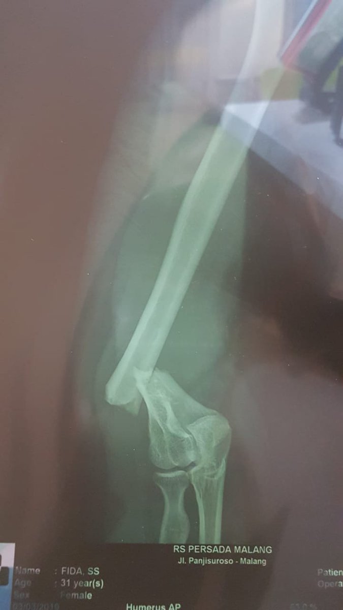 Rek iki Dakir kecelakaan...
dibutuhkan kira2 15jt utk bisa brangkat operasi (dr perkiraan total biaya skitar 30jt)
Lek sekiranya ada yg bisa bantu tolong transfer yah
Ng rekening BCA 0152110608 an. Anggoro Danu Wibowo
Suwun yah