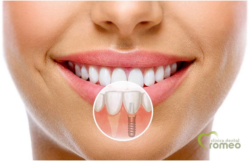 🤭 ¿Perdiste alguna pieza dental❓
 💚 Descubre las consecuencias de no reponer una pieza dental pérdida.
 👉 Haz clic y descúbrelo ahora => bit.ly/2Evf4Qp
 #PiezasDentales #Consecuencias #PerdidaOsea #ProblemasDigestivos #Dentista #ClinicaDental