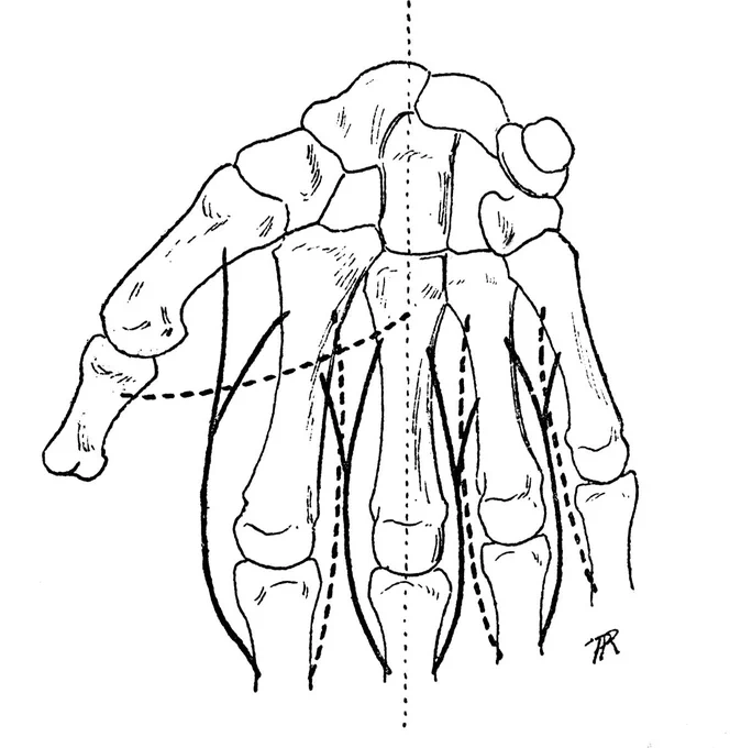 ちなみに背側骨間筋の作用は、中手指節関節(MP関節)の外転なので、第三指(中指)は内転が存在せず、母指側と小指側どちらに動かしても外転になる。見た目の動作と記述が食い違うので、第三指は橈屈と尺屈としている教科書もある。 