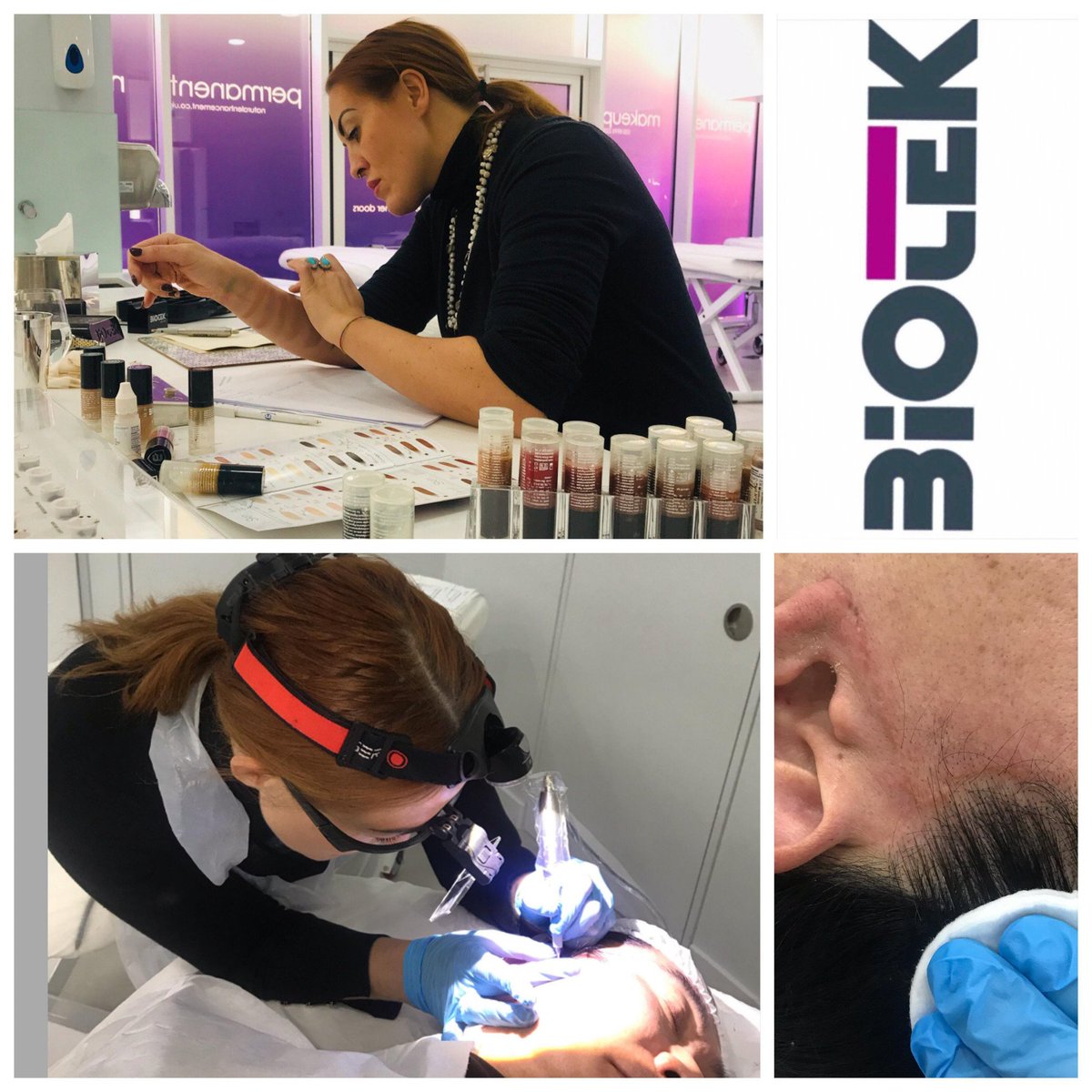 NaturalEnhance's tweet photo. Really enjoyed working with our learner Lauren Davies who recently attended our Scar Camouflage Course. We loved sharing with her the amazing world of medical micro-pigmentation. https://t.co/GusGnN7lcE