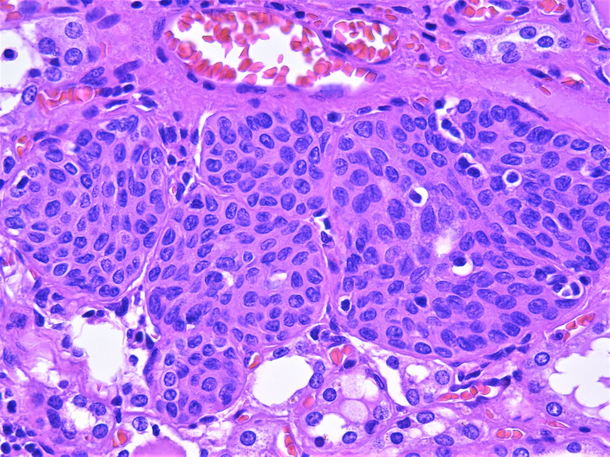 Patholwalker's tweet photo. Solid cell nest of thyroid. #pathology https://t.co/Jm302dNIHs